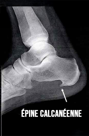 photo-épine-calcanéenne