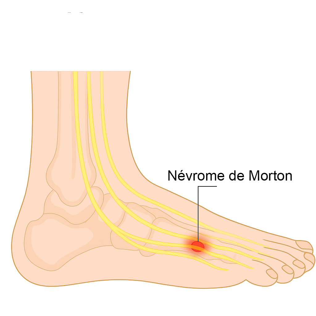 Névrome-de-Morton