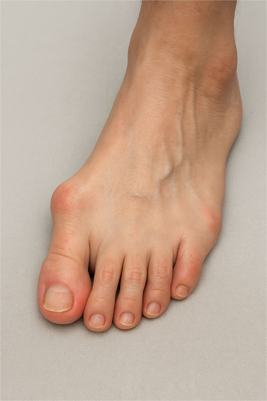 pied-avec-hallux-valgus