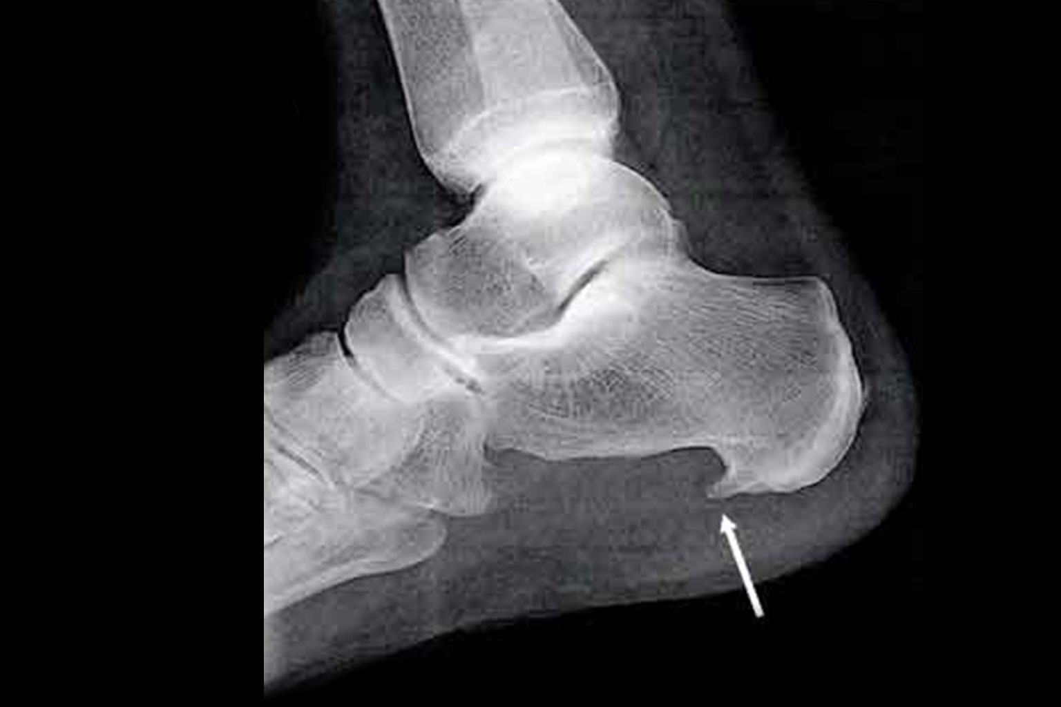 Photo-d'une-radio-d’une-épine-calcanéenne